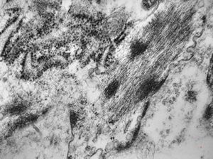 M,5y. | rhabdomyosarcoma vestibuli oris M,5y. | rhabdomyosarcoma vestibuli oris